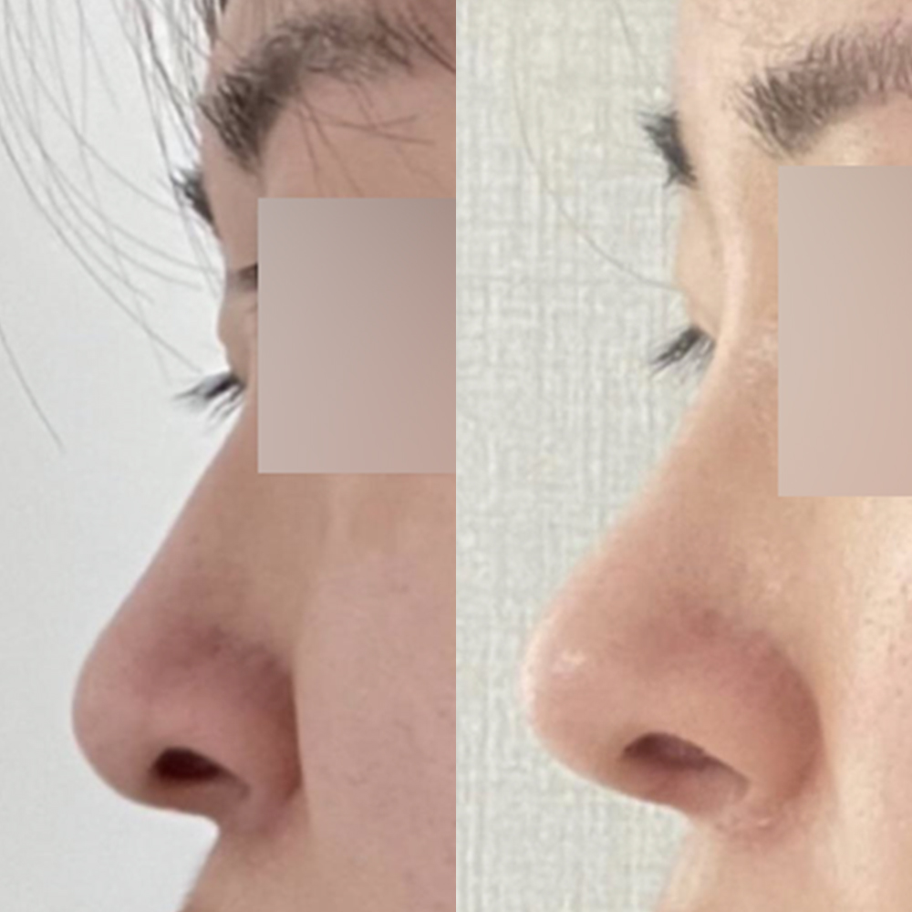 Cuối cùng mình đã phẫu thuật chiếc mũi từng là mặc cảm lâu năm của mình ~