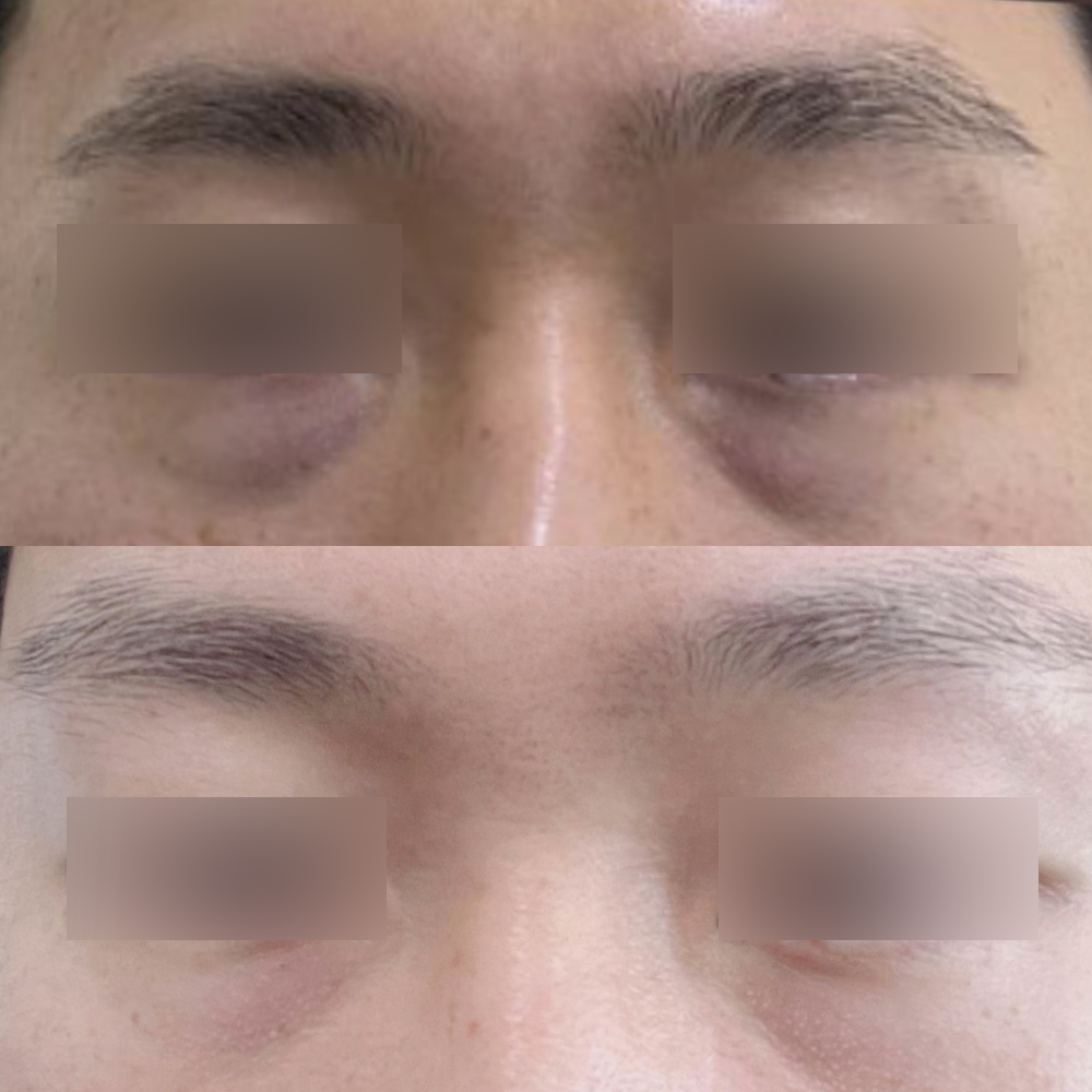 Đánh giá sau 2 tháng tái tạo mỡ dưới mắt :)