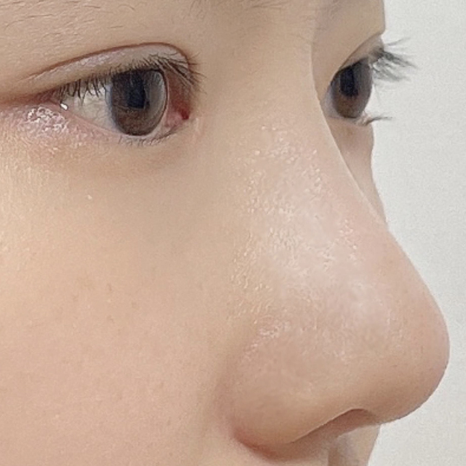 Mình đã phẫu thuật mắt và mũi ở Wolhae vào tháng 4 và đã được 2 tháng rồi ㅎㅎ