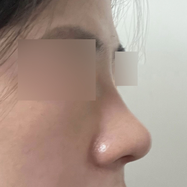 Mình đã phẫu thuật thu nhỏ đầu mũi