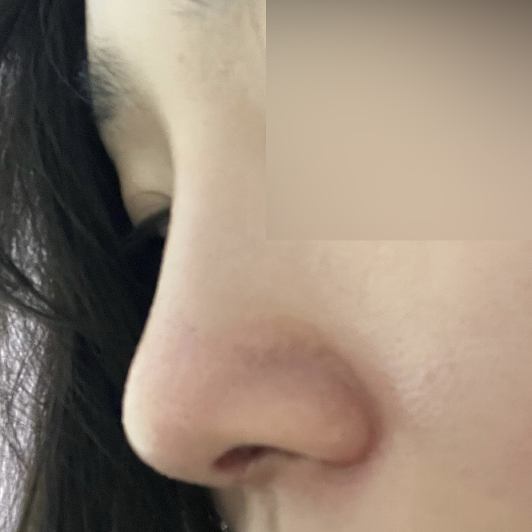 Mình đã phẫu thuật với bác sĩ Shim Jung-hwan của Weavers vào đầu tháng 7!