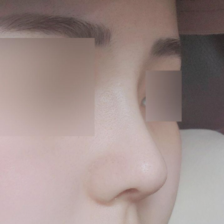 Đã 1 tháng kể từ khi phẫu thuật mũi