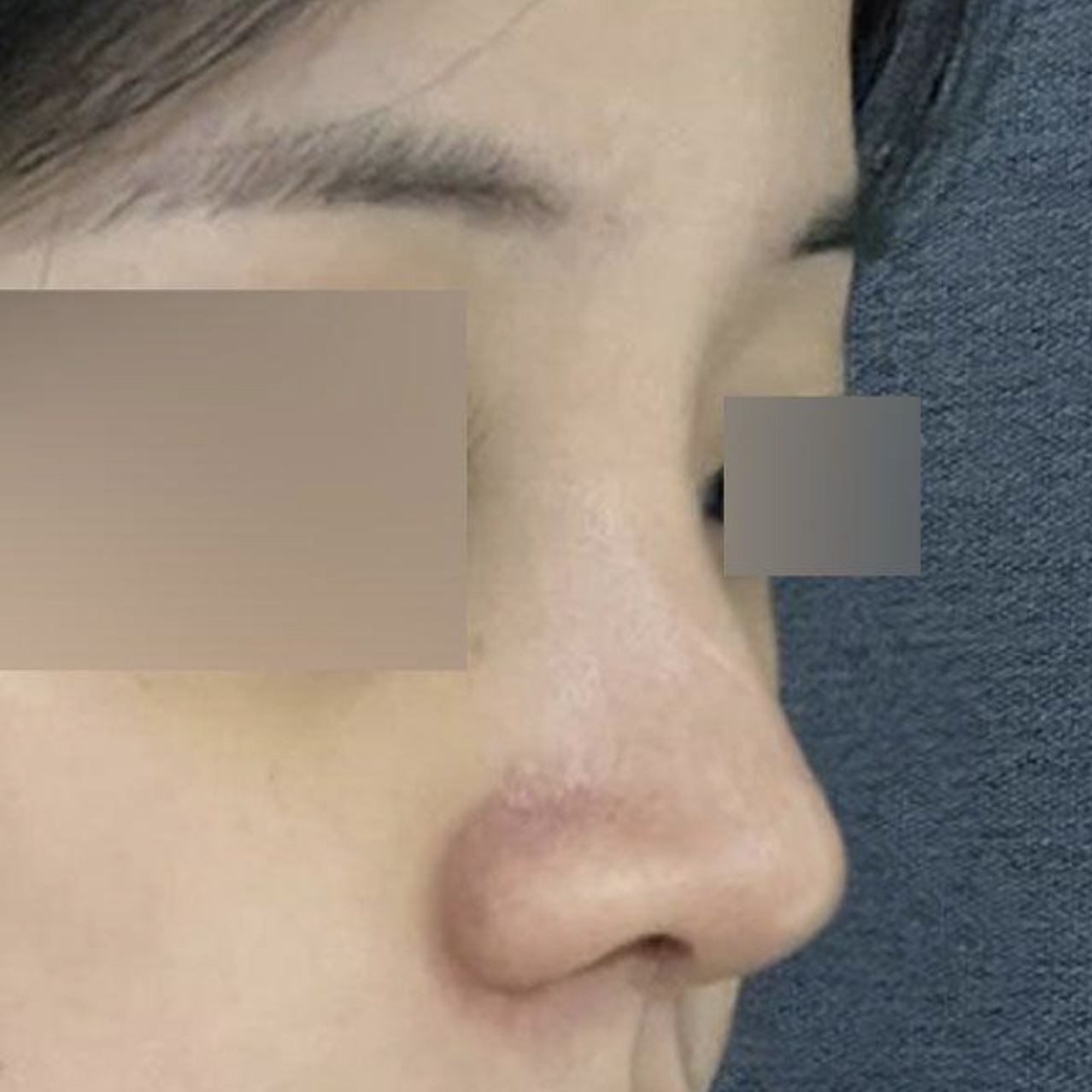 Mình đã phẫu thuật được 2 tuần rồi ạ