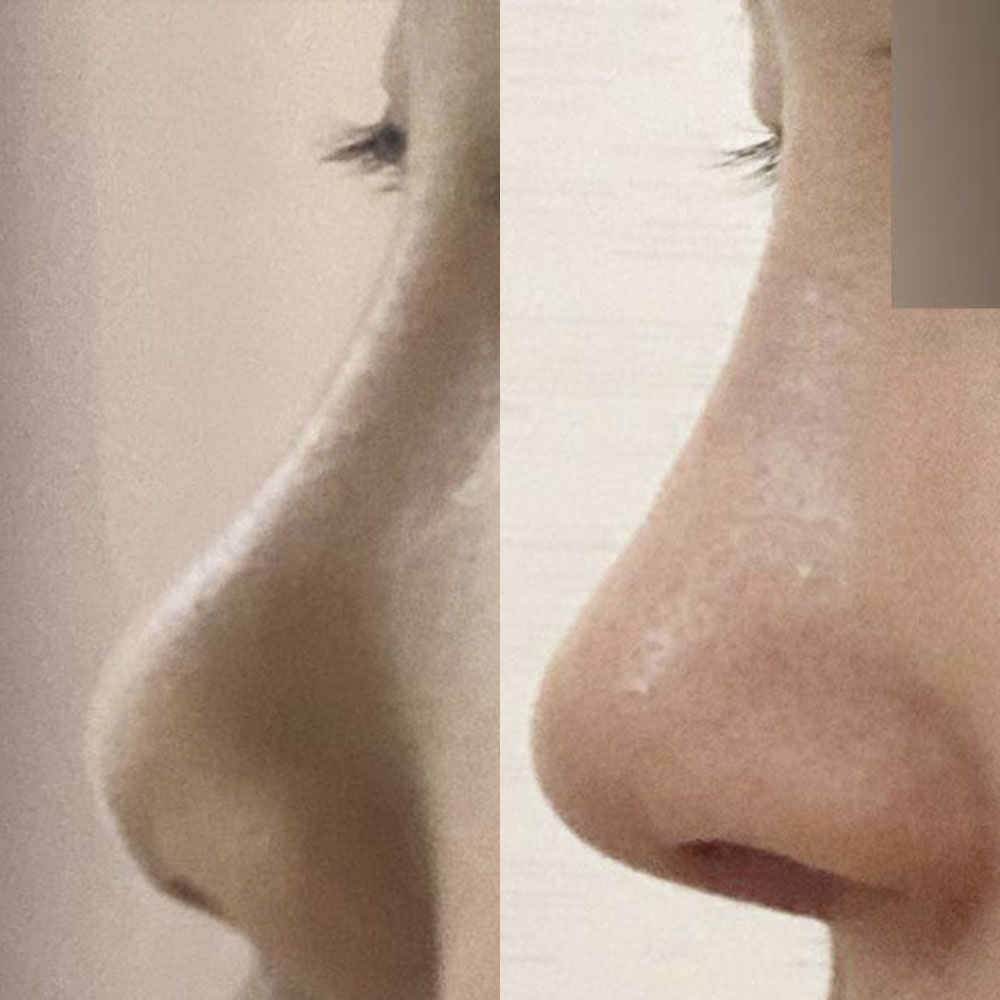 Mình đã phẫu thuật với bác sĩ Shim Jung Hwan được 2 tuần rồi