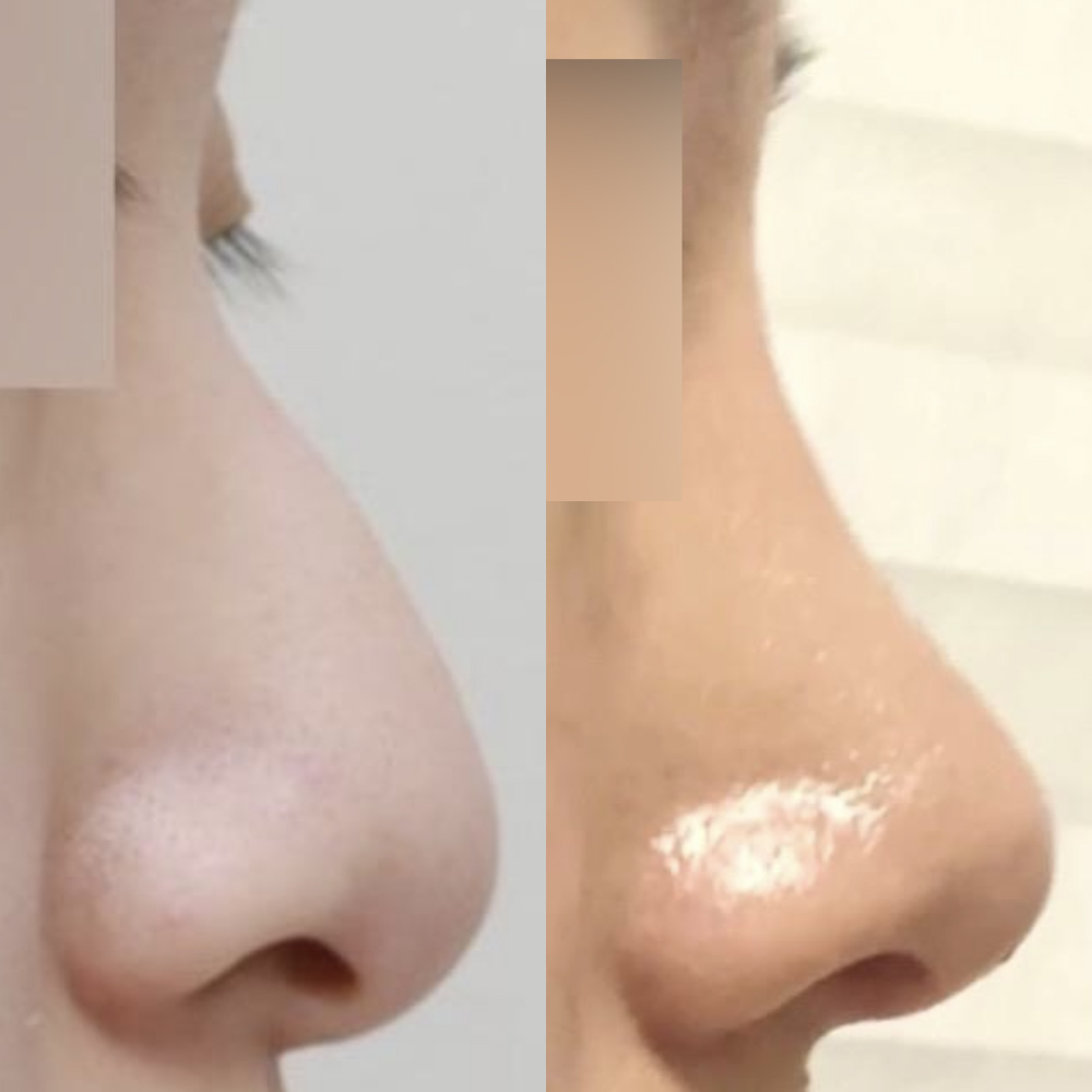 Mình đã phẫu thuật mũi lần đầu tiên không dùng chất liệu độn!