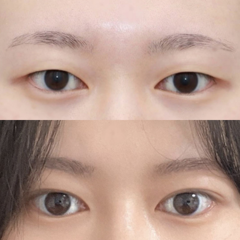 Đánh giá sau 3 tháng phẫu thuật