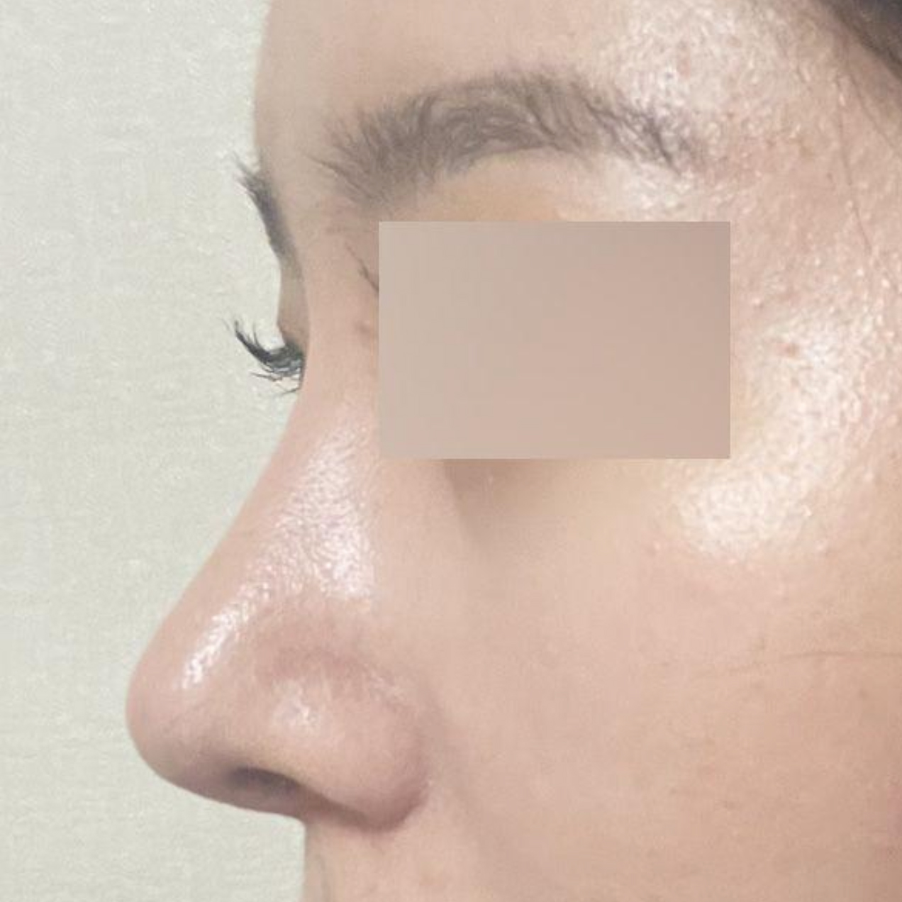 Đã 2 tuần kể từ khi phẫu thuật mũi tẹt