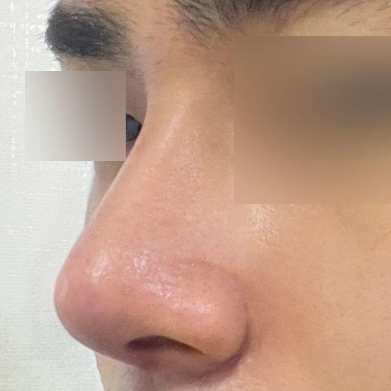 Đã 2 tuần kể từ khi mình phẫu thuật tại bệnh viện phẫu thuật thẩm mỹ Weavers.