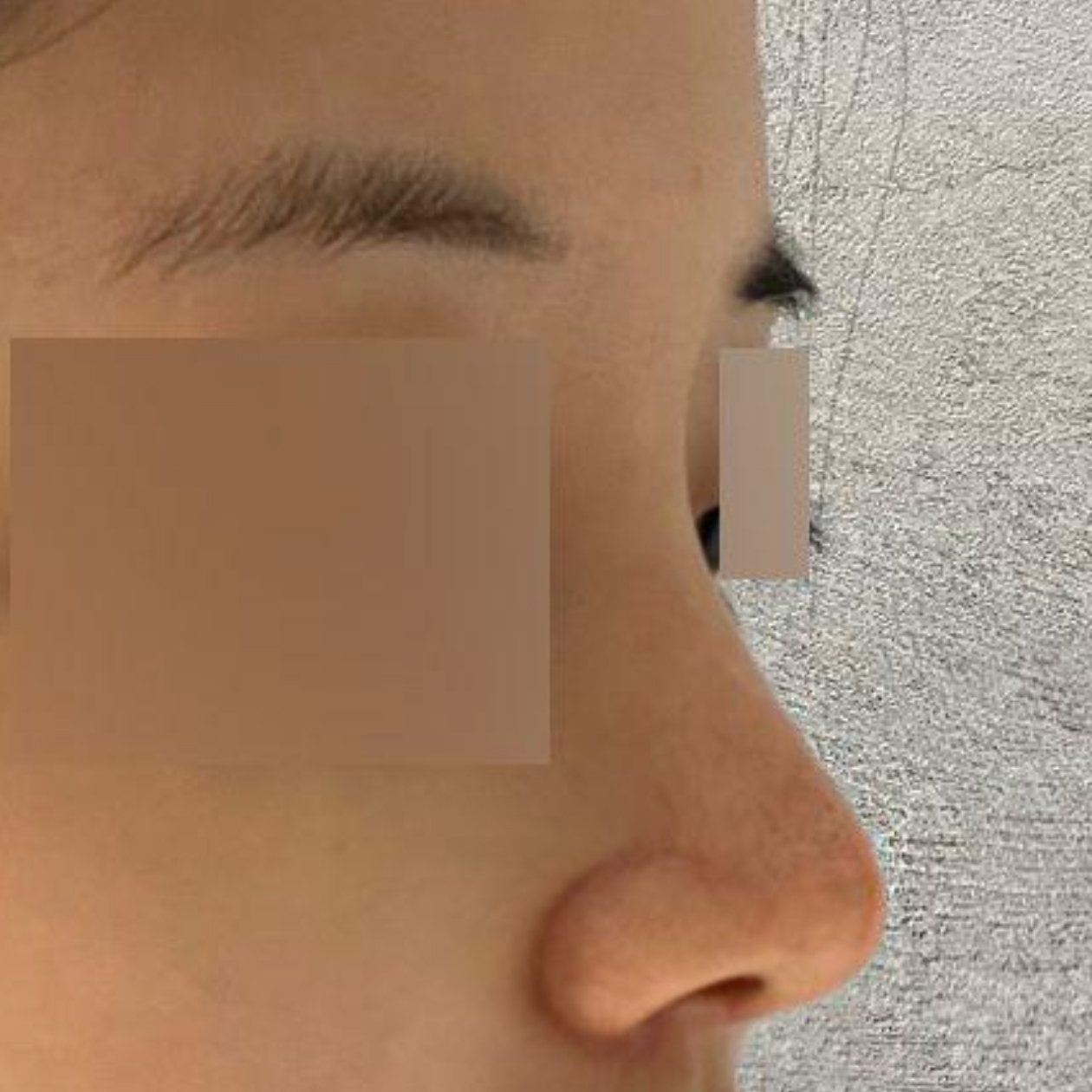 Đã hai tháng kể từ khi phẫu thuật