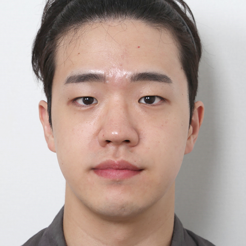 #Cắt mí một phần #Chỉnh sửa mắt #Sống mũi (silicone) #Đầu mũi (sụn tự thân)