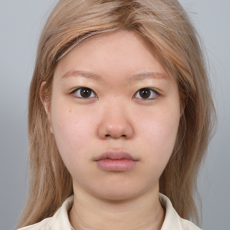 #Sống mũi (silicone) #Đầu mũi (sụn tự thân) #Chỉnh sửa mũi tròn