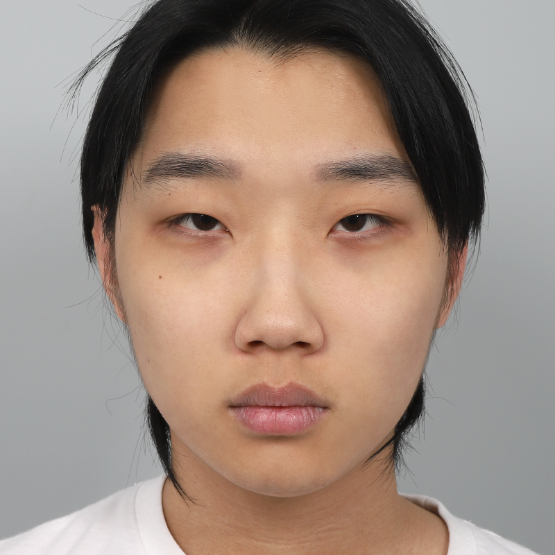 #Cắt mí một phần #Chỉnh sửa mắt #Sống mũi (silicone) #Đầu mũi (sụn tự thân) #Thu nhỏ cánh mũi