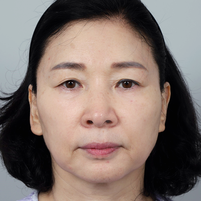 #Nâng mí trên #Nâng mí dưới Nâng cung mày Nâng cơ mặt