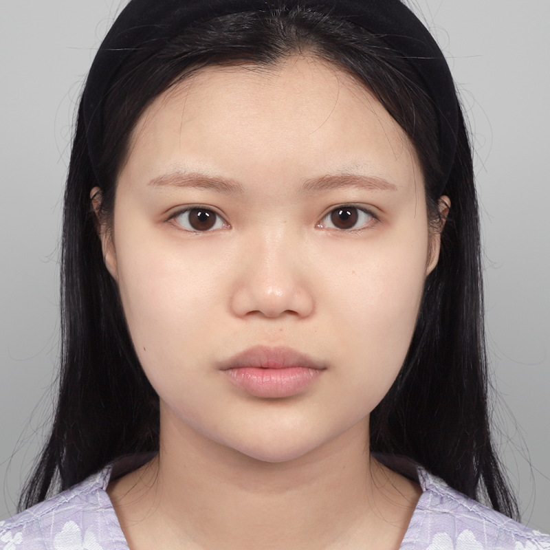 #Sốngmũi(silicone) #Đầumũi(sụn tự thân) #Mũingắn(mũi hếch) chỉnh sửa