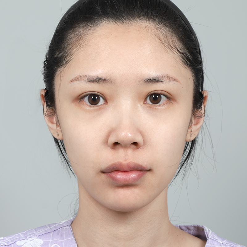 #Sống mũi (silicone) #Đầu mũi (sụn tự thân)