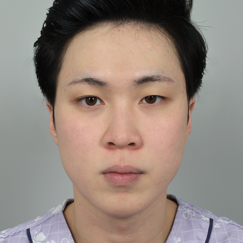 #Cắt mí một phần #Chỉnh sửa mắt #Sống mũi (silicon) #Đầu mũi (sụn tự thân)