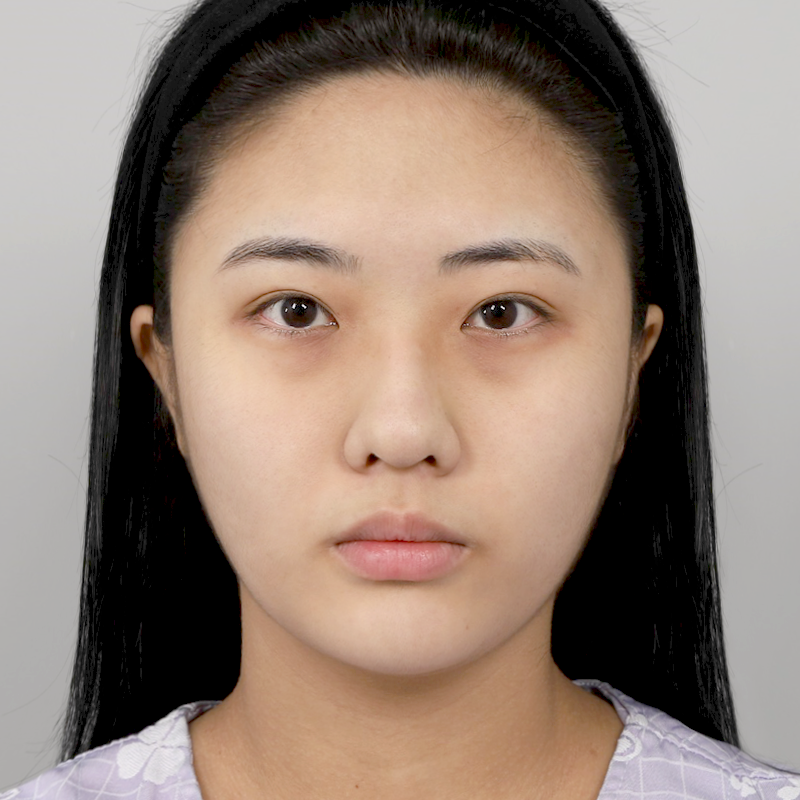 #Sống mũi (silicone) #Đầu mũi (sụn tự thân) #Phẫu thuật nâng mũi bằng sụn sườn tự thân