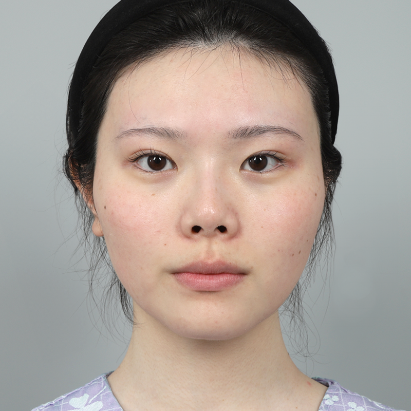 #Sốngmũi(silicone) #Đầumũi(sụn ​​tựthân) #Nângmũibằngsụnsườntựthân #Chỉnhsửamũingắn(mũihếch)